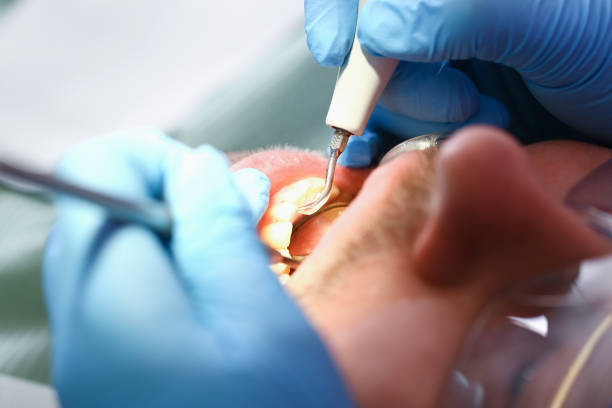 Best Emergency Root Canal Treatment in Beggs, OK