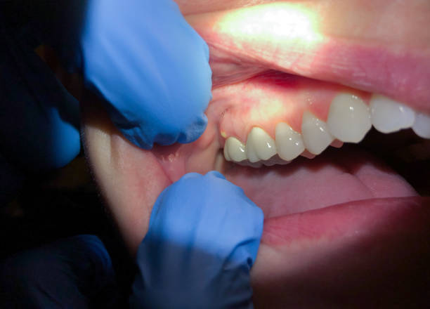 Best Emergency Dental Care for Broken or Chipped Teeth in Beggs, OK